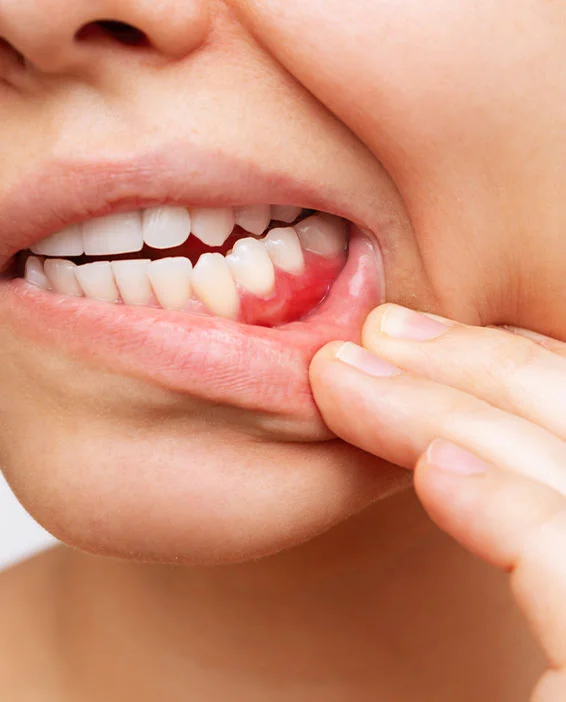 detailed view of periodontal treatment and gum disease therapy with modern dental equipment Image